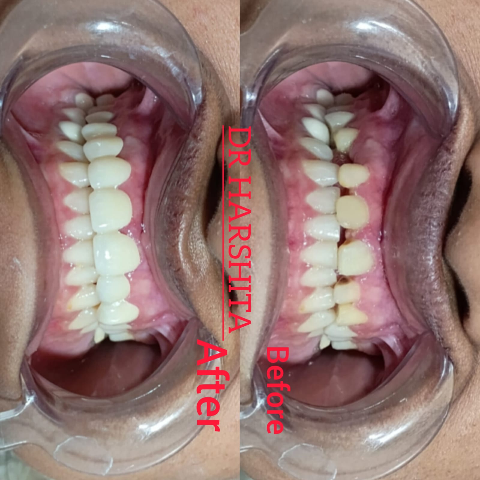 Before & After - Hair Transplant